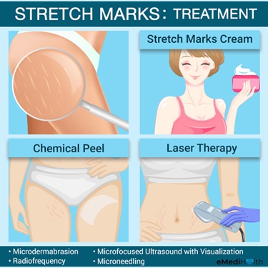 How Much Is Laser Therapy For Stretch Marks