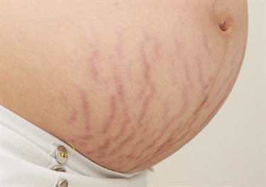 Stretch Marks On Genital Area