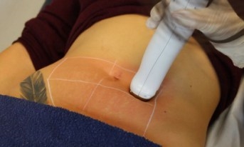 Derma Roller Stretch Mark Reviews