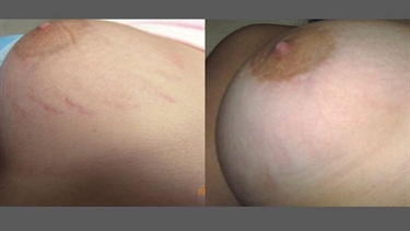 Stretch Marks On Breast Pictures