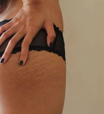 Best Pregnancy Stretch Mark Lotion