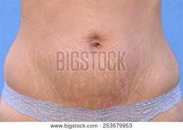 Stretch Mark Removal Before After