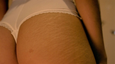 Massaging Stretch Marks