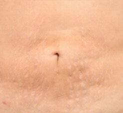 Stretch Mark Removal For Men