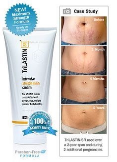 Stretch Mark Complex