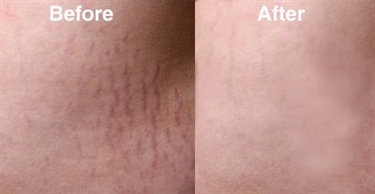 Stretch Mark Oils And Creams