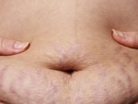 Stretch Marks In Groin Area