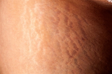 How Long Do Stretch Marks Take To Heal