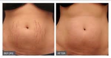 Latina Stretch Marks