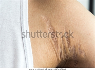 Men With Stretch Marks