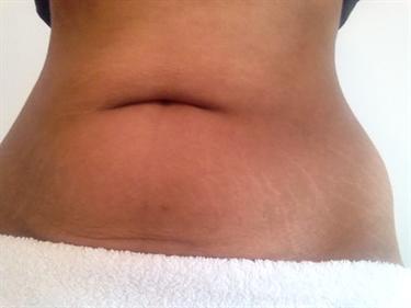 How To Hide Stretch Marks On Arms