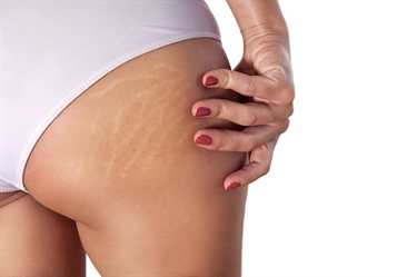 Can You Get Stretch Marks From Scratching