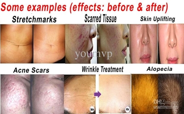 Stretch Marks In Puberty