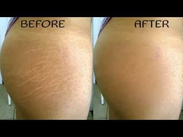 How To Cover Up Stretch Marks On Arms
