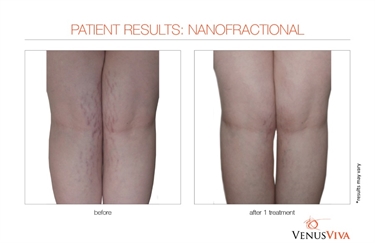 The Best Stretch Mark Removal Cream