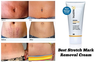 Stretch Mark Pictures