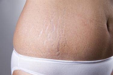 Wide Stretch Marks