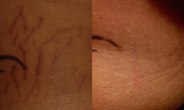 Strivectin For Existing Stretch Marks