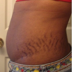 Stretch Mark Removal San Diego