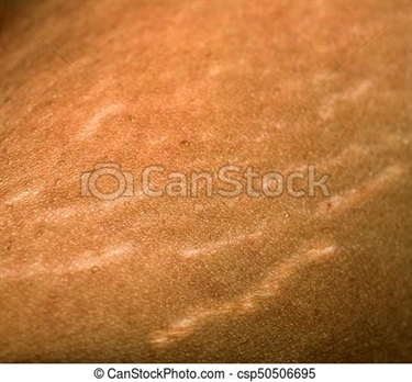 Scratching Stretch Marks