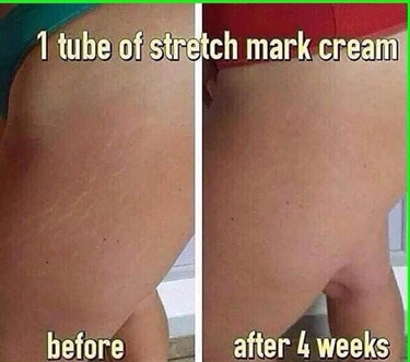 Neck Stretch Marks