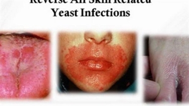 What Is The Best Lotion For Stretch Marks