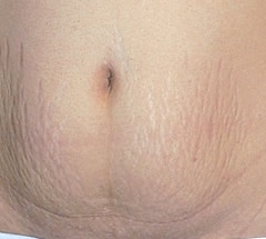 How To Get Rid Of Red Stretch Marks On Thighs