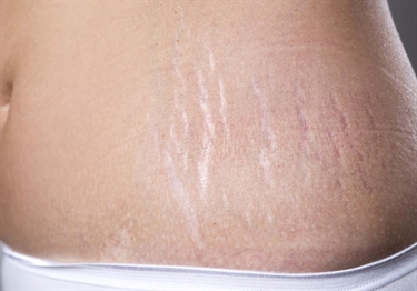 Do Guys Like Stretch Marks