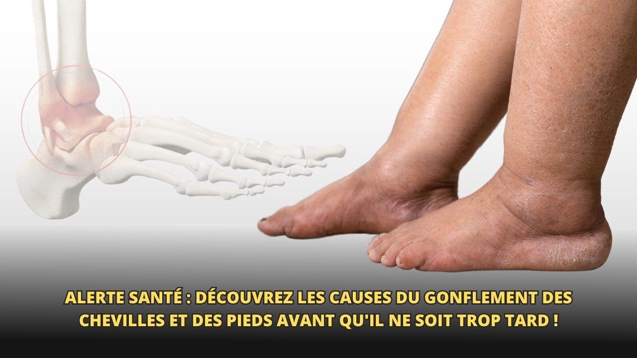 Vos pieds et vos chevilles sont enflés ? Voici quoi faire avant de consulter un médecin