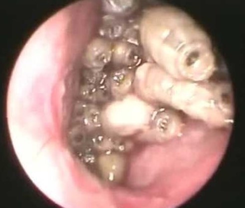 Un médecin de Floride retirent 150 larves à l’intérieur du nez d'un homme.