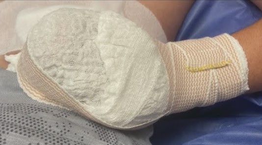 Des pétards de Floride du 4 juillet devenus des demis- grenades pour des jeunes adolescents à en faire arracher les doigts.