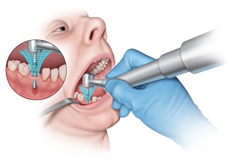 En Floride votre prochain assistant dentiste sera un ROBOT dentaire du nom de Yomi pour tous vos besoins d’implants dentaires.