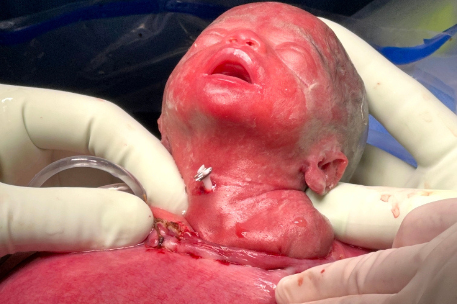 Découvrez l’histoire du « bébé miracle » né deux fois en Floride Découvrez l’histoire du « bébé miracle » né deux fois en Floride