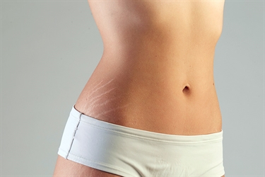 How To Heal Stretch Marks On Breast