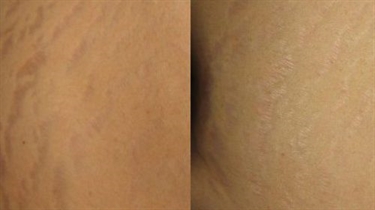 6 Weeks Pregnant Stretch Marks On Breasts