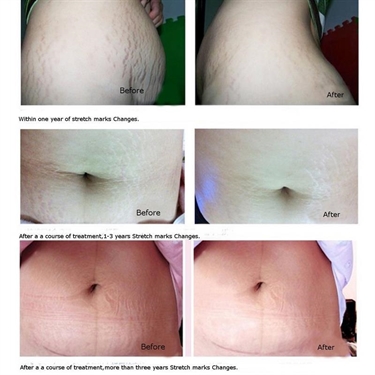 Can Stretch Marks Look Like Breast Indents