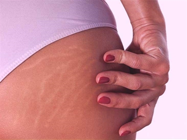 Stretch Marks Solution