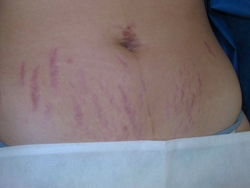 Heal Stretch Marks