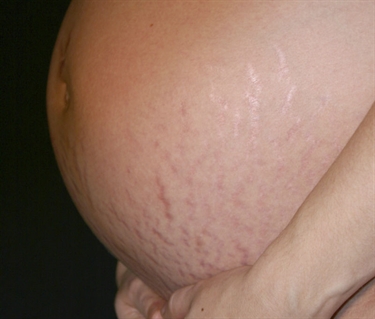 How To Avoid Stretch Marks Bodybuilding