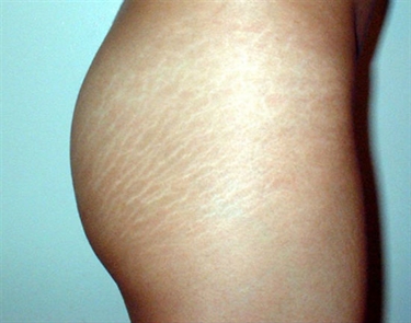 How To Get Rid Of Stretch Marks On Breasts During Pregnancy