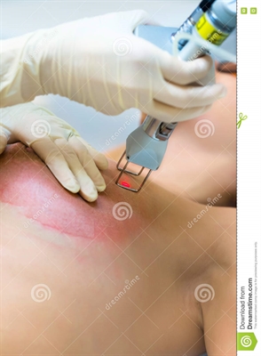 How To Treat Stretch Marks