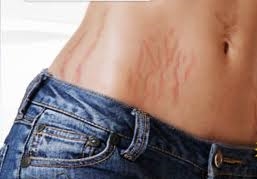 Teenage Stretch Marks Solutions