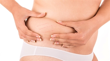 Skinny But Have Stretch Marks