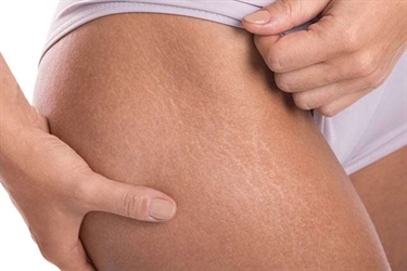 How To Get Rid Of Bad Stretch Marks