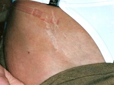 How To Treat Red Stretch Marks