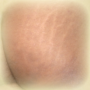 How To Get Rid Of Male Stretch Marks