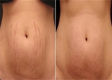 How To Get Stretch Marks Removed
