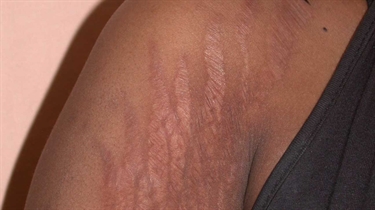 How To Help Stretch Marks Fade