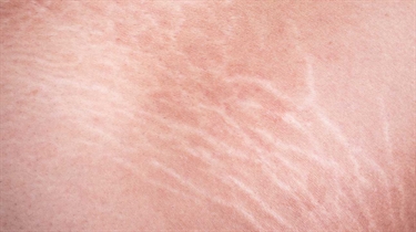 Cushing's Stretch Marks Breast