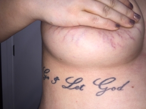 Breast Red Stretch Marks